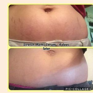 Stretch Marks Serum